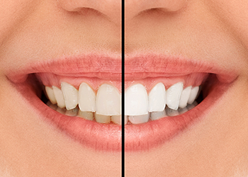 Cosmetic Dentistry & Teeth Whitening