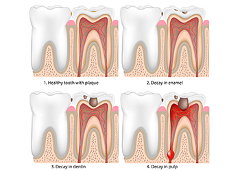 Dental Cavities and Caries Chart