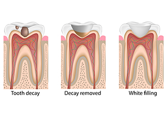 dental fillings in Chicago, IL