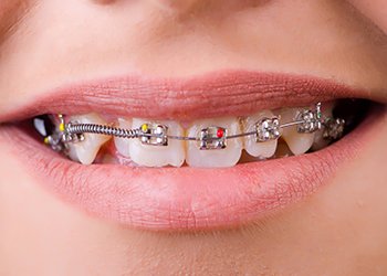 Orthodontic Emergencies-Braces Dental Metal