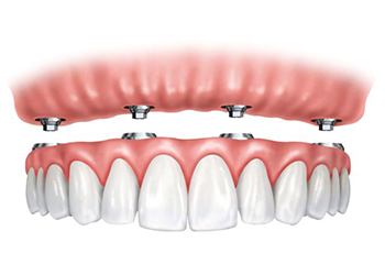 Overdentures and Fixed Implant Bridges | 1st Family Dental