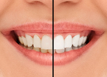 Teeth Whitening Options