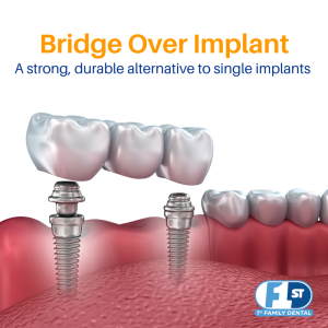 Best affordable option teeth replacement
