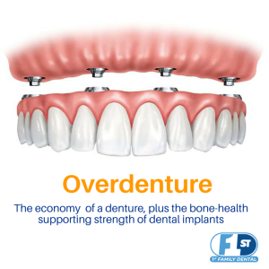 Best affordable option teeth replacement