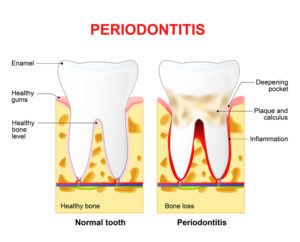 Periodontitis or pyorrhea - deep dental cleaning vs regular cleaning