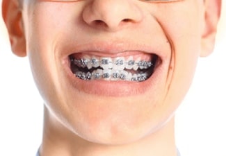 orthodontic services - orthodontic emergencies