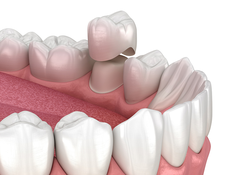Dental Crowns